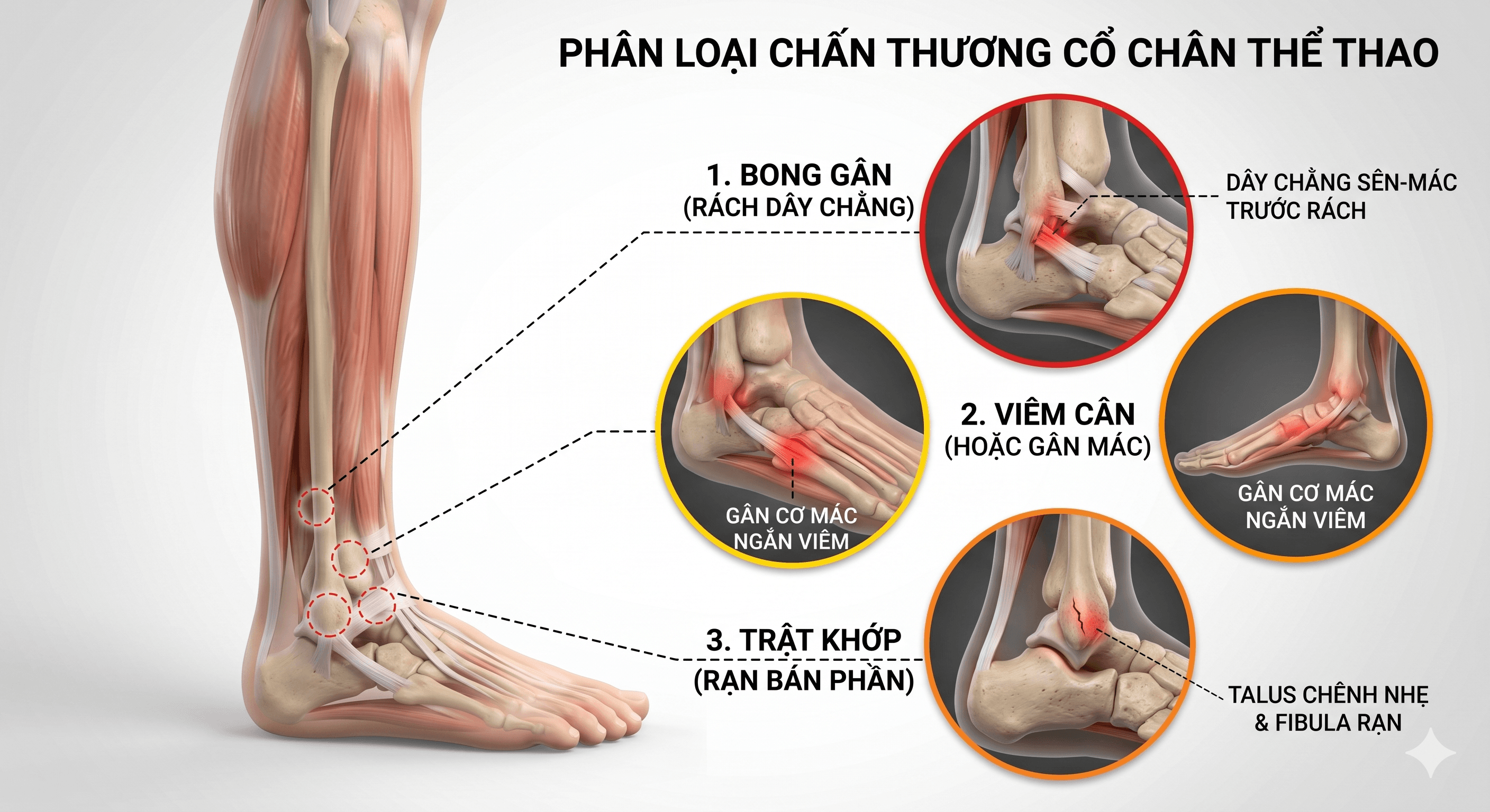 Các Chấn Thương Trong Thể Thao Thường Gặp