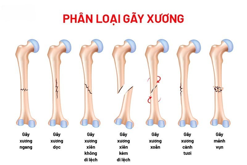 Các Kiểu Gãy Xương Thường Gặp
