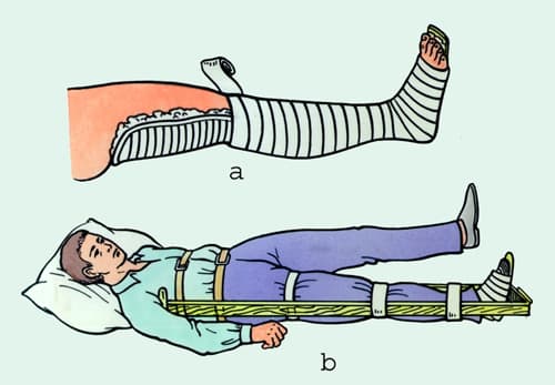 Cố Định Gãy Xương Cẳng Chân