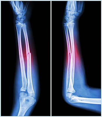 Dấu Hiệu Chắc Chắn Gãy Xương: Cách Nhận Biết Và Xử Trí