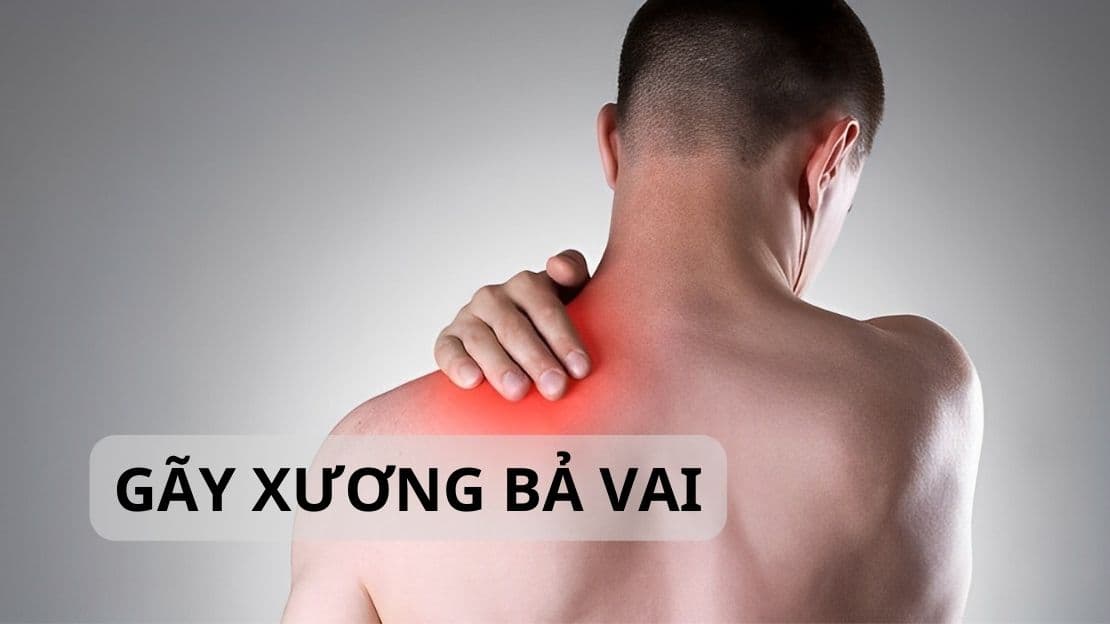 Gãy Xương Bả Vai: Dấu Hiệu, Phân Loại Và Phác Đồ Phục Hồi Chức Năng Hiện Đại
