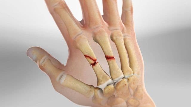 Gãy Xương Bàn Tay: Dấu Hiệu, Các Loại Chấn Thương Và Phác Đồ Phục Hồi Chức Năng Cầm Nắm