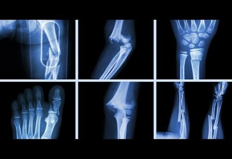 Gãy Xương: Dấu Hiệu Chắc Chắn, Triệu Chứng Và Phương Pháp Điều Trị Hiệu Quả