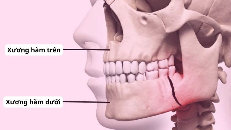 Gãy Xương Hàm Dưới: Dấu Hiệu Nhận Biết, Phân Loại Và Phác Đồ Điều Trị Phục Hồi