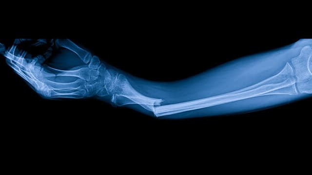 Nguyên Nhân Gãy Xương: Tổng Hợp Các Yếu Tố Thường Gặp
