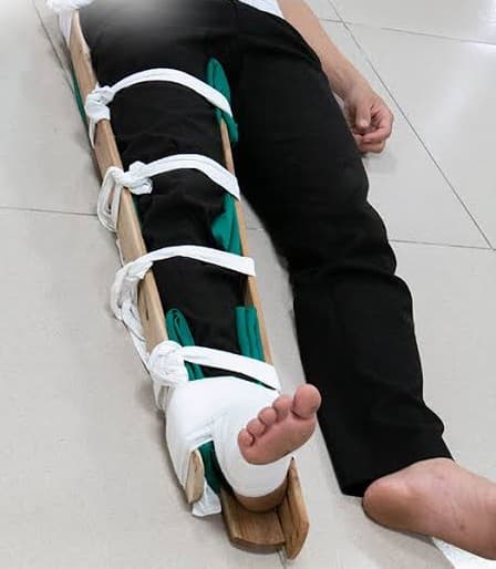 Sơ Cứu Gãy Xương: Các Bước Cấp Cứu Chuẩn Y Khoa