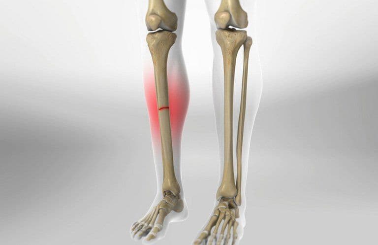 Tổng Hợp Các Nguyên Nhân Dẫn Đến Gãy Xương Thường Gặp