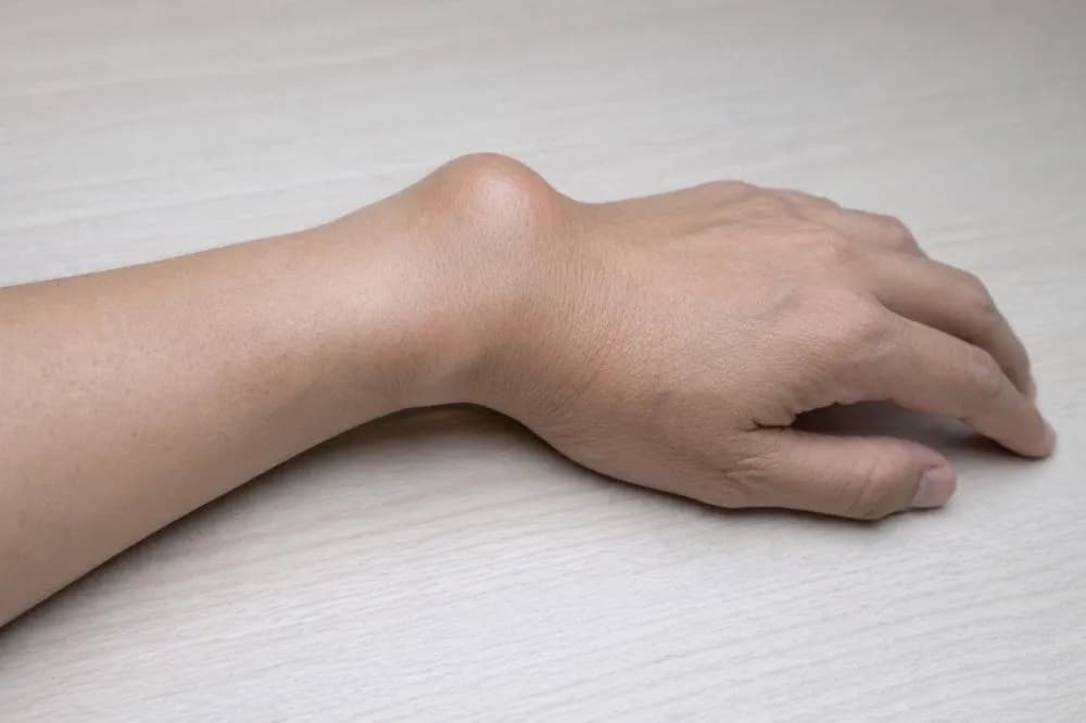 Trật Khớp Tay: Dấu Hiệu, Nguyên Nhân Và Cách Điều Trị
